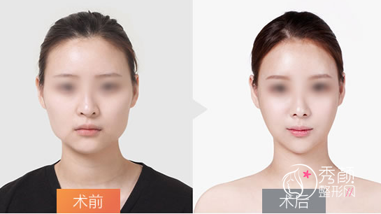 北京协和医院磨骨怎么样，大概需要多少钱？