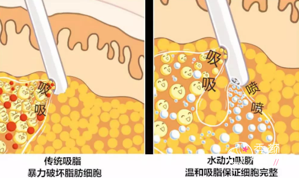 广州抽脂哪家医院比较正规，哪家医院吸脂技术好？