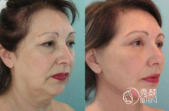 沈阳做拉皮手术哪家医院好？沈阳杏林、百嘉丽、省人民医院等。