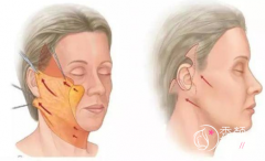 上海拉皮手术哪家医院好，大概需要多少钱？