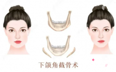 广州磨骨哪家医院好？广州磨骨大概需要多少钱？