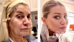 青岛哪家三甲医院做拉皮手术比较好？