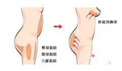 上海九院自体脂肪隆胸怎么样，大概需要多少钱？