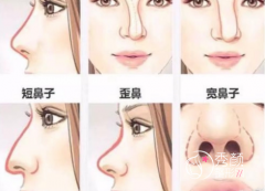 山东大学齐鲁医院隆鼻怎么样，大概需要多少钱？