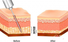上海九院抽脂手术怎么样|附上海九院抽脂价目表一览