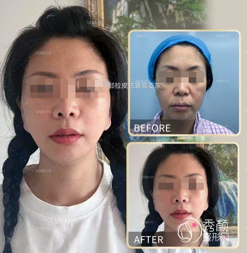 北京哪家医院做拉皮好？北京华韩高亚东拉皮手术做得怎么样？附拉皮案例
