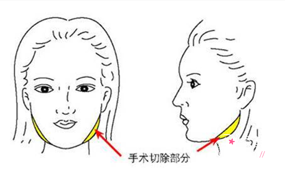 上海九院磨骨哪个医生好？上海九院磨骨多少钱？