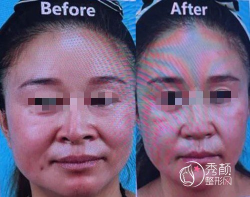 重庆美莱李任隆鼻怎么样，有没有失败案例？附鼻修复案例