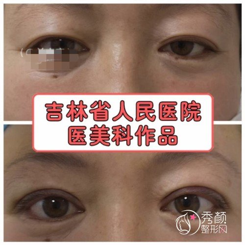 吉林省人民医院关小康修复双眼皮怎么样，贵不贵？附双眼皮修复案例