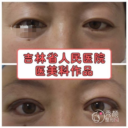 吉林省人民医院关小康修复双眼皮怎么样，贵不贵？附双眼皮修复案例