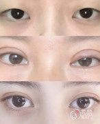 福州海峡整形医院做双眼皮怎么样，多少钱？