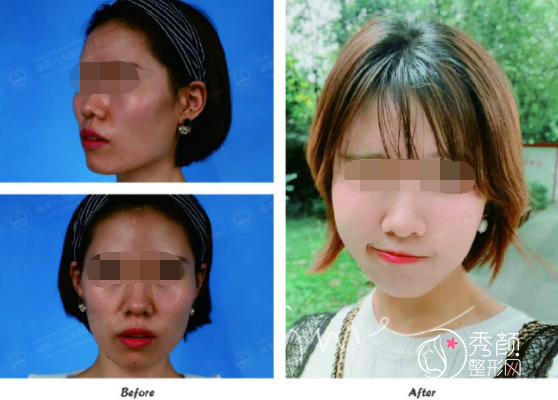 八大处唐勇脂肪填充做得好吗？附唐勇面部脂肪填充案例