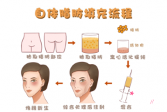 北京八大处脂肪填充怎么样|附自体脂肪填充价格表