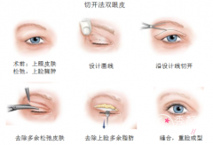 北京协和医院做双眼皮手术怎么样，大概多少钱？