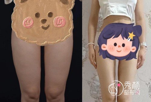 青岛华颜美张庆吸脂怎么样，附张庆大腿吸脂案例