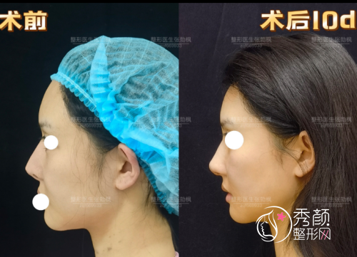 上海张勍枫隆鼻怎么样，附张勍枫隆鼻案例|个人资料