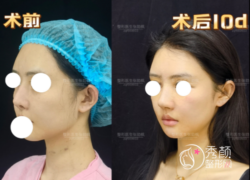 上海张勍枫隆鼻怎么样，附张勍枫隆鼻案例|个人资料