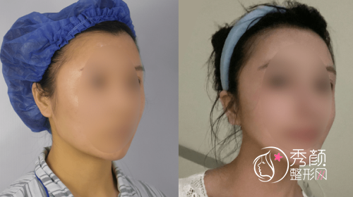 四川友谊医院赵延峰磨骨怎么样|附赵延峰磨骨案例