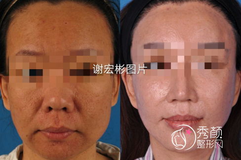 北医三院谢宏彬做拉皮手术怎么样|附拉皮手术案例及面部提升价格表