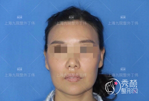 上海九院丁伟做拉皮手术怎么样|附丁伟拉皮手术案例