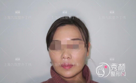 上海九院丁伟做拉皮手术怎么样|附丁伟拉皮手术案例