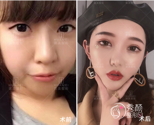 西安画美罗金刚做双眼皮怎么样|附罗金刚双眼皮案例