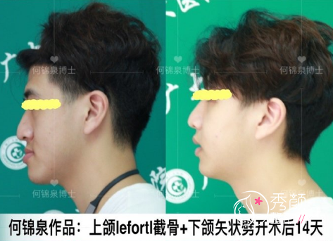 广州广大何锦泉做正颌手术怎么样|附正颌手术案例