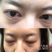 去上海九院做了玻尿酸填充泪沟，总共花了5000不到！