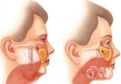 北京小拉皮哪个医生做得好，李晓东、穆宝安、黄寅守、高亚东、杨大平等。