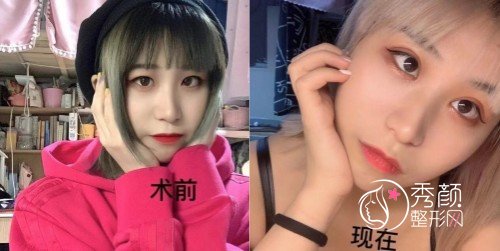 武汉协和医院王巍双眼皮怎么样|附王巍双眼皮案例