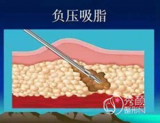 <b>负压吸脂vs水动力吸脂vs威塑吸脂vs5G天使光雕哪个好，区别是什么？</b>