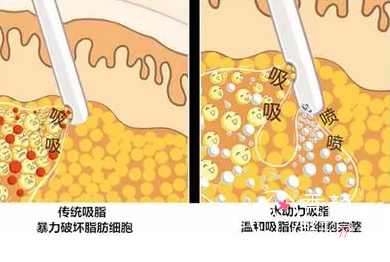 负压吸脂vs水动力吸脂vs威塑吸脂vs5G天使光雕哪个好，区别是什么？