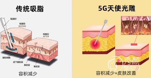 负压吸脂vs水动力吸脂vs威塑吸脂vs5G天使光雕哪个好，区别是什么？