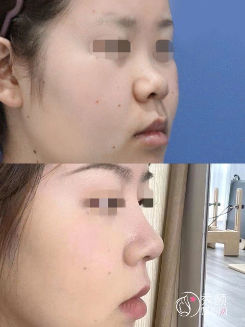 宫风勇隆鼻怎么样，有没有失败案例？附宫风勇真实隆鼻案例