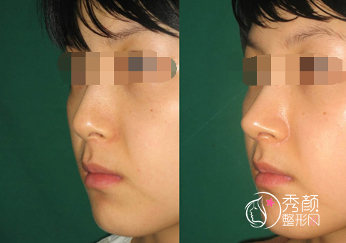 上海隆鼻医生排名推荐,范荣杰/韩嘉毅/李健/张洪波等上榜