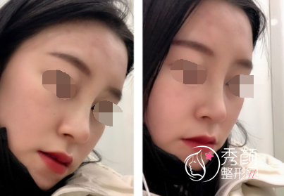 上海微加张亚伦医生做鼻子怎么样，有没有失败案例？