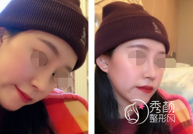 上海微加张亚伦医生做鼻子怎么样，有没有失败案例？
