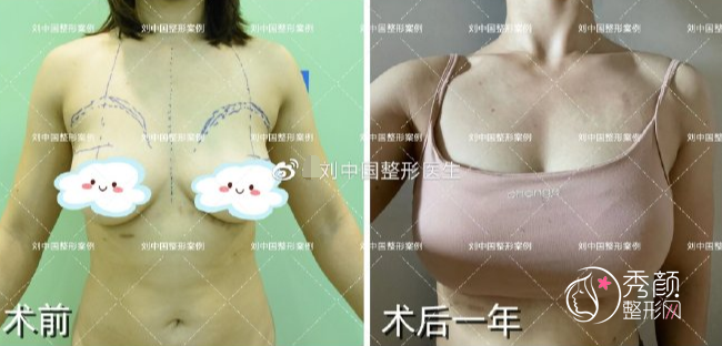 成都玉之光刘中国做自体脂肪填充怎么样？附自体脂肪隆胸案例