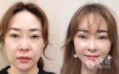 成都拉皮手术哪个医院医