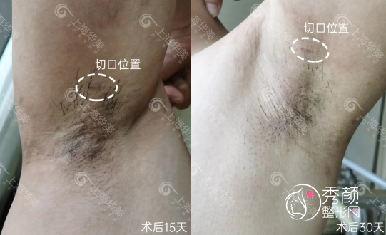 上海华美腋臭手术案例曝光，术后疤痕隐蔽且无异味！
