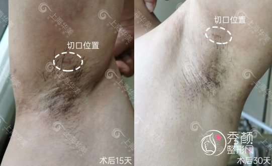 上海华美腋臭手术案例曝光,术后疤痕隐蔽且无异味!