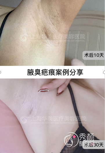 上海华美腋臭手术案例曝光,术后疤痕隐蔽且无异味!