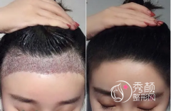 成都三甲医院植发哪家好，华西医院、第二人民医院、军区总医院