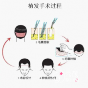 北京八大处植发怎么样，2023北京八大处植发费用