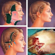 上海哪家医院做拉皮手术好，上海伯思立、上海九院、上海华山医院等。