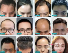 东莞植发正规医院哪家好？排名？植发收费价格表？