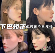 正颌手术效果怎么样？有没有后遗症？正颌手术对比照片