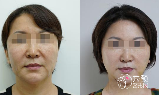 广州拉皮手术哪家医院好？广州韩妃vs曙光医院vs广州紫馨医院对比