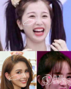 印第安纹与泪沟的区别？注射玻尿酸、拉皮手术等六种医美方法教你有效去除印