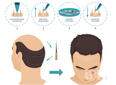 国内哪家公立医院有植发科？国内公立医院植发科室推荐